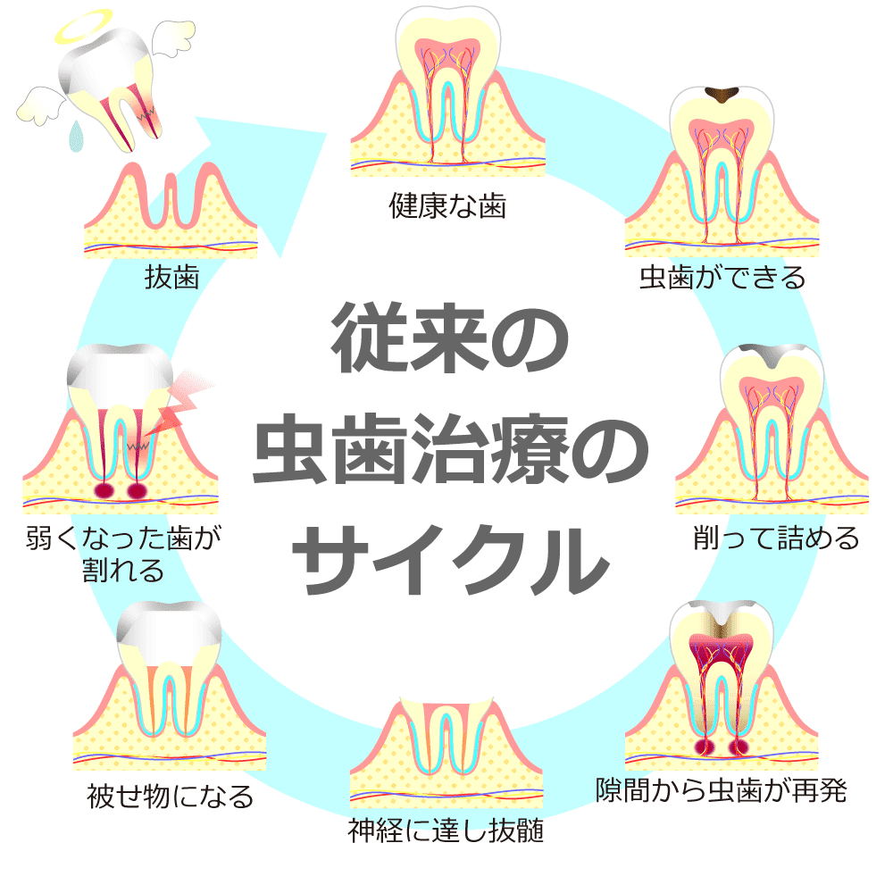 従来の虫歯のサイクル